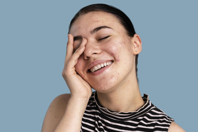 How to Get Rid of Blemishes?