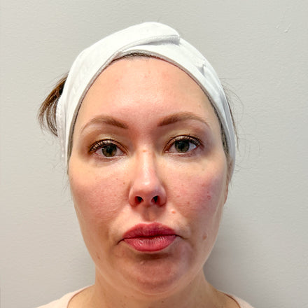 before skin treatment