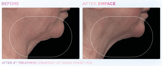 emface treatment before after