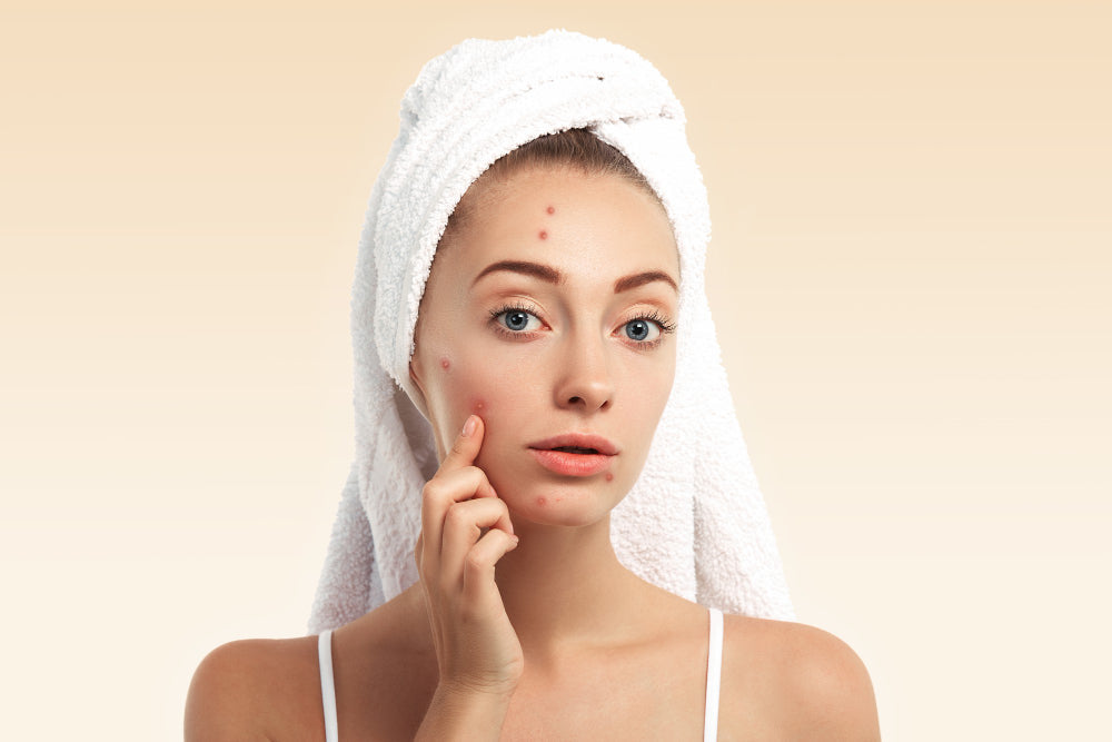How to Tell If Acne Is Hormonal or Bacterial?
