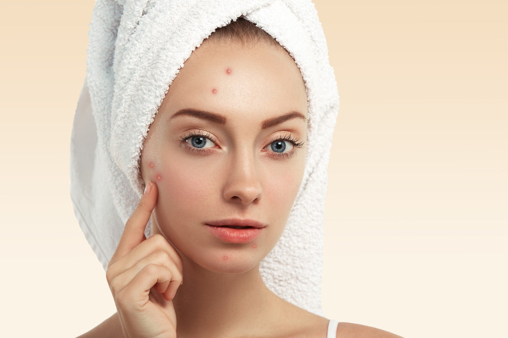 Difference Between Acne and Blemishes