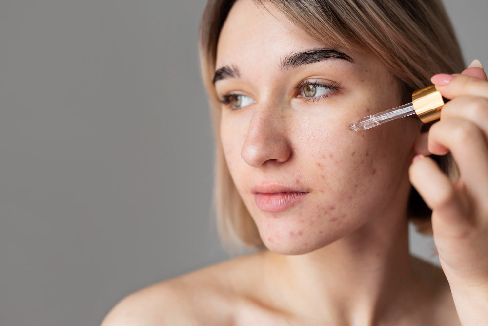 Does Retinol Help with Acne?