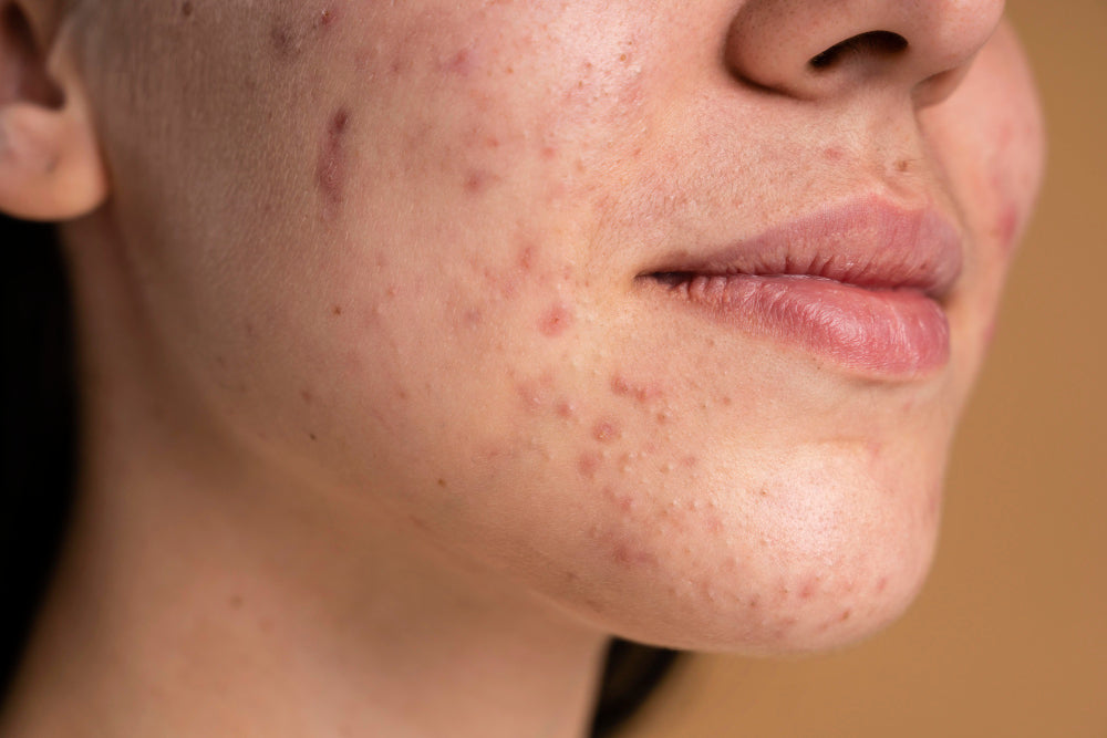 Acne Marks Vs Acne Scars: What's the Difference?
