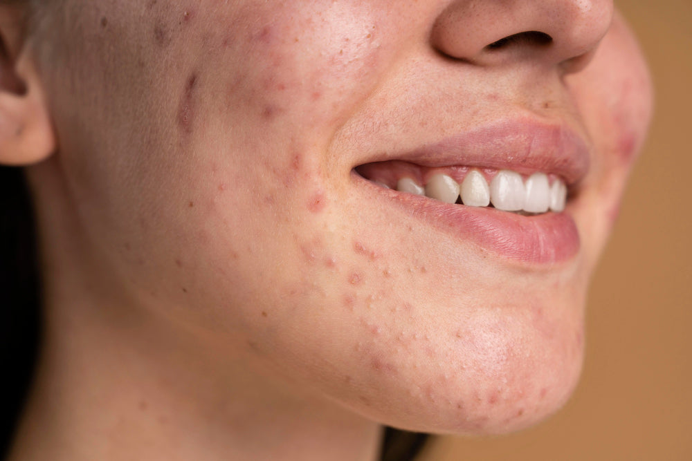 What is Textured Skin? (Causes & Cure)