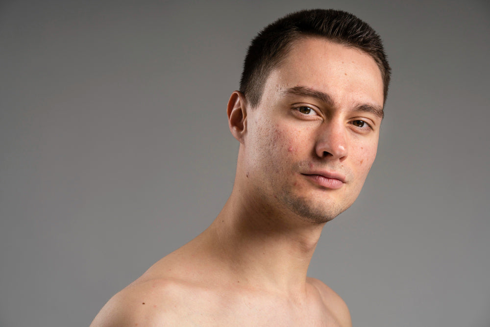 Does Dermaplaning Cause Acne?