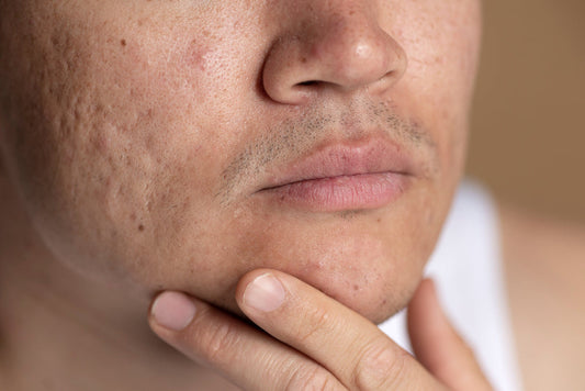 How to Minimize Pores?