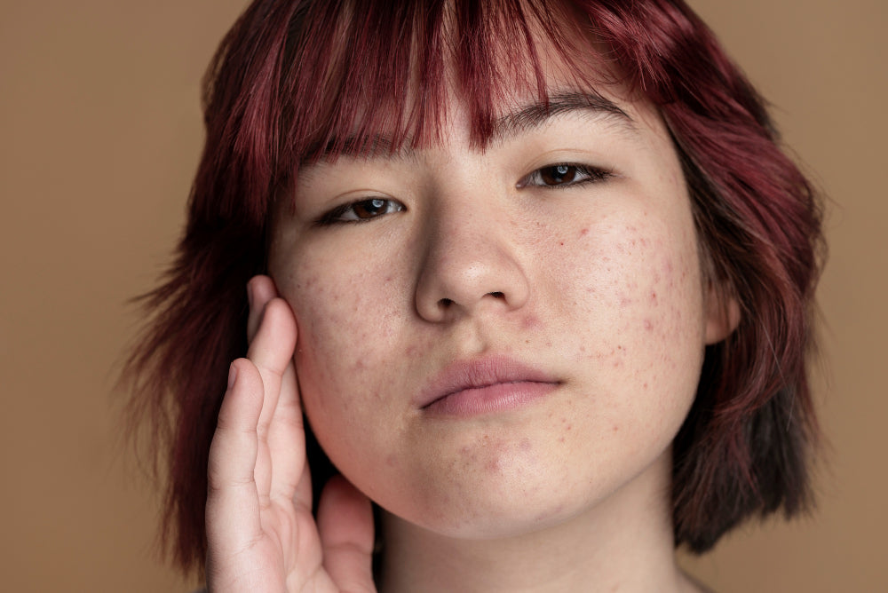 Can Salicylic Acid Cause Acne?
