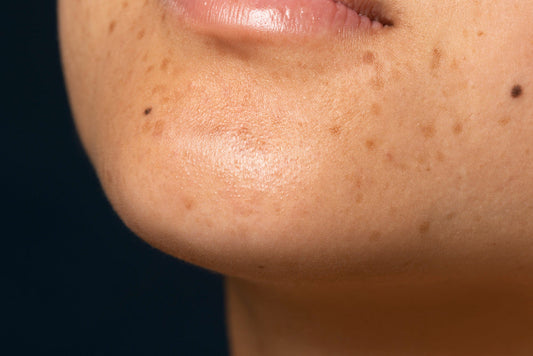 Does Salicylic Acid Help With Blackheads?