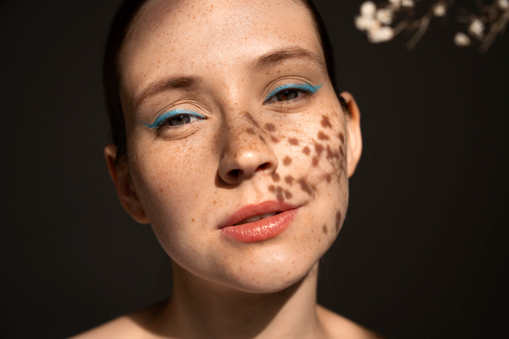 What Is Hyperpigmentation? A Deeper Look at Uneven Skin Tone