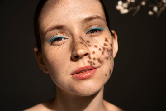 What Is Hyperpigmentation? A Deeper Look at Uneven Skin Tone