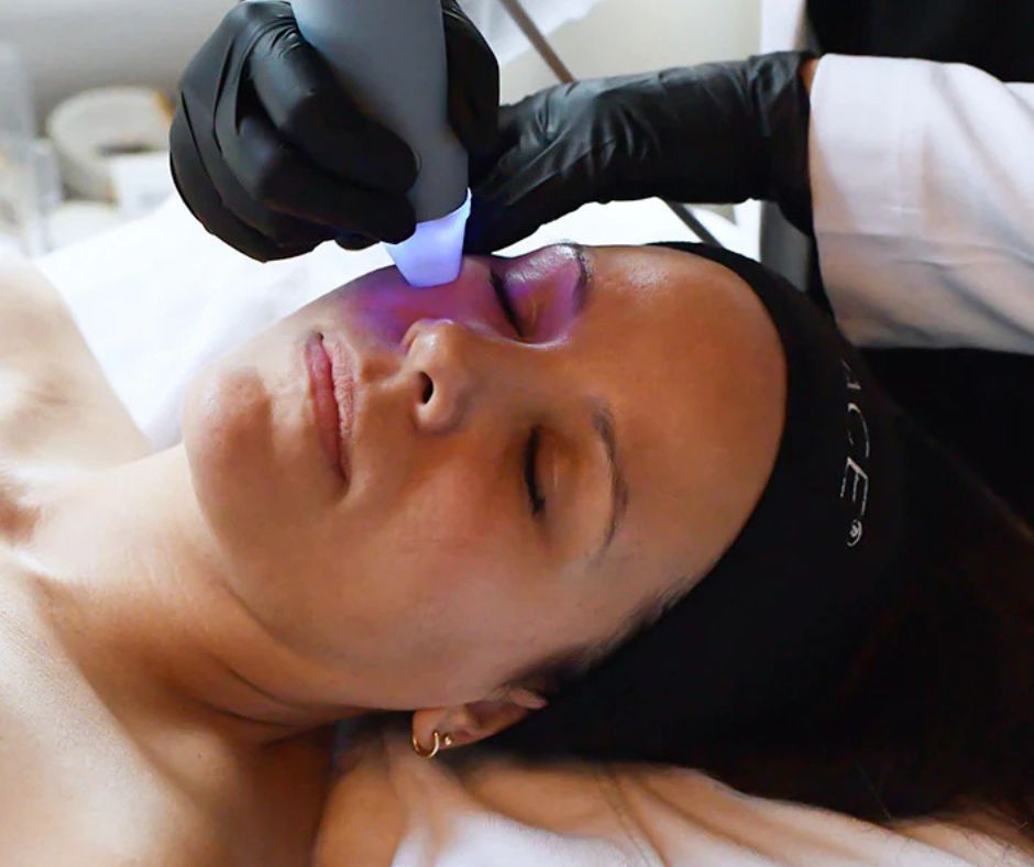 How Many Microneedling Sessions for Acne Scars?