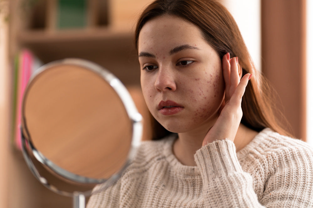Breakout after microneedling