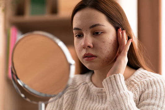 Breakout after microneedling