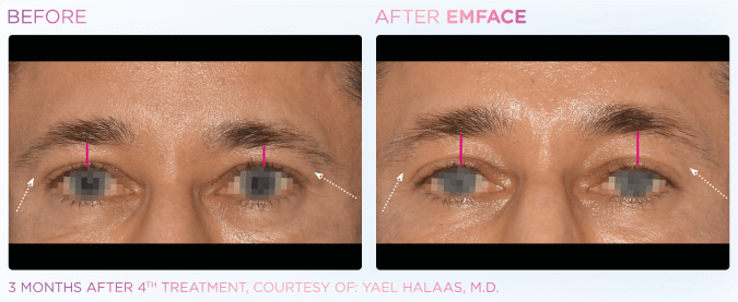 emface before and after